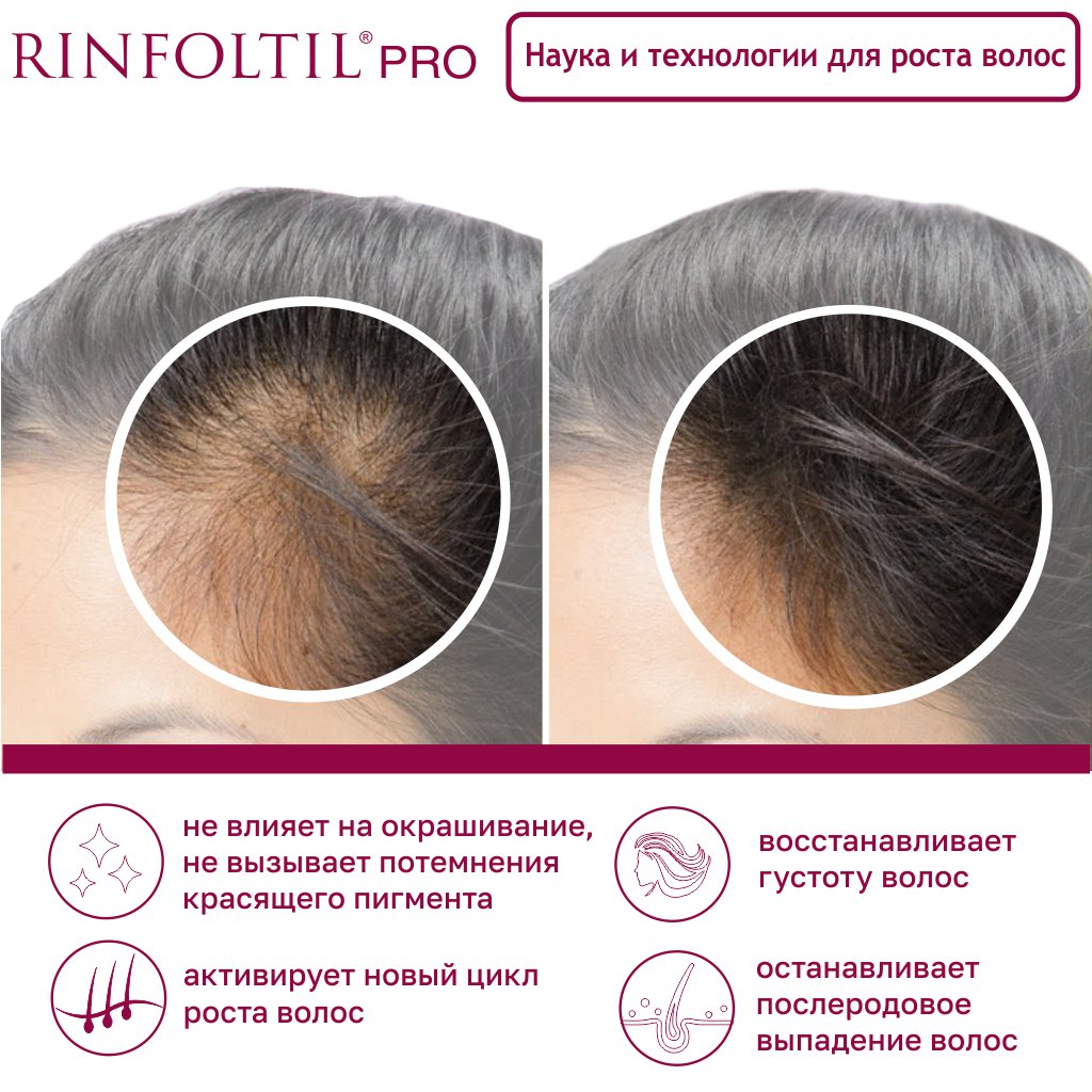 Ринфолтил про сыворотка нанолипосомальная против сильного выпадения и для роста волос для женщин флакон